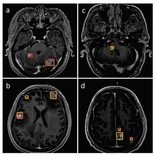 AI-detectie van hersenmetastasen in MRI-scans